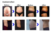 Profession Lipopolysin Vertical Shape Non-Contact Fat Reducing Machine Body Slimming Equipment Vacuum Weight Loss Equipment