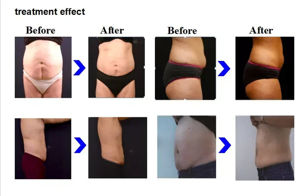 Profession Lipopolysin Vertical Shape Non-Contact Fat Reducing Machine Body Slimming Equipment Vacuum Weight Loss Equipment